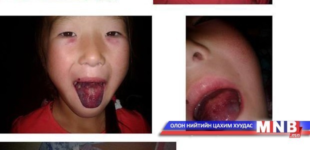 Н.Энхбилэг охинд туслах хандивын аян үргэлжилж байна