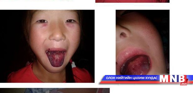 Н.Энхбилэг охинд туслах хандивын данс нээгдлээ