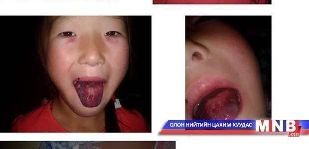 Н.Энхбилэг охины онош тодорлоо