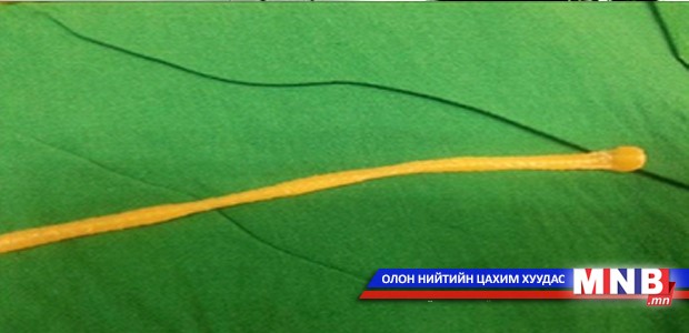 Хүүгийн гэдэснээс 3.5 метр урт шимэгч хорхой гарчээ