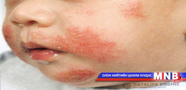 Таны хүүхэд диатезтай бол юуг анхаарах вэ