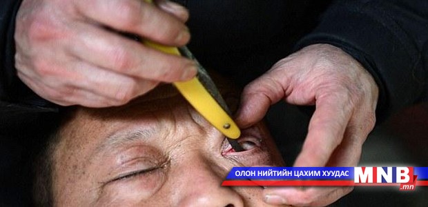 Нүдний цөцгийг мэсээр цэвэрлэдэг