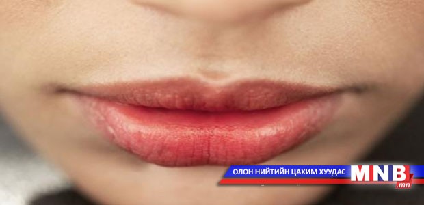 А, Е, С витамин дутагдсанаас уруул омголтож хагардаг