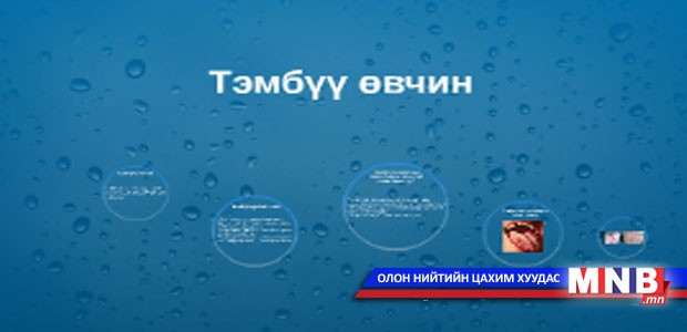 Төрөлхийн тэмбүү өвчинтэй 16 хүүхэд мэндэлжээ