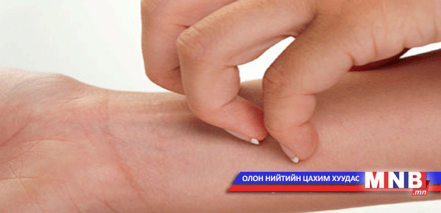 Наранд түлэгдсэн арьстайгаа хэрхэн "харьцах" вэ?