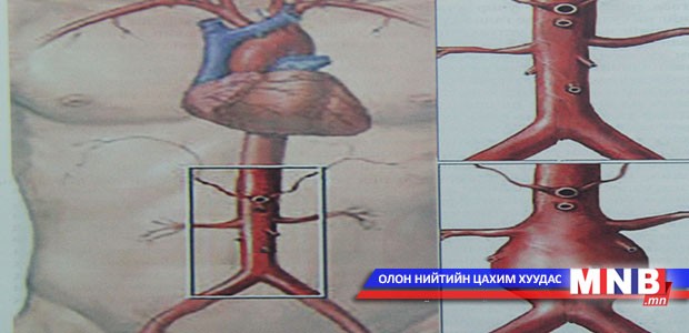 Аневризм буюу судасны цүлхэн