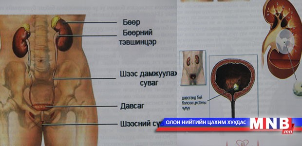 Бөөр шээсний замын эмгэгийн тухай