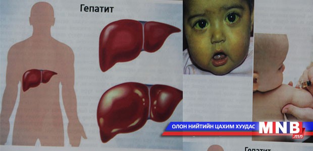 Бохир гарын өвчин