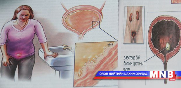 Давсагны үрэвсэл буюу цистит