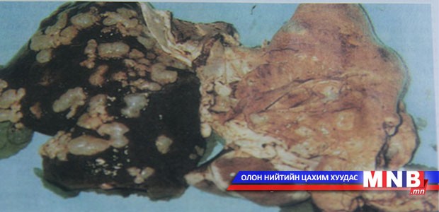 Бэтгэрэх эмгэгийн тухай