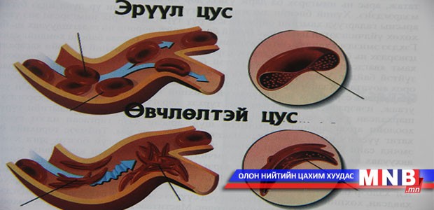 Гемофили буюу цусны өвчин