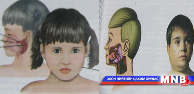 Гахайн хавдар