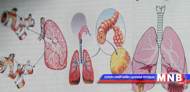 Гуурсан хоолой тэлэгдэх эмгэг