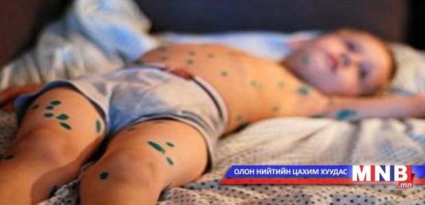 Улсын хэмжээнд улаанбурхан өвчний 6727 тохиолдол бүртгэгджээ
