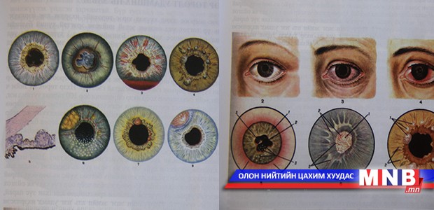 Иридоциклит буюу нүдний үрэвсэл