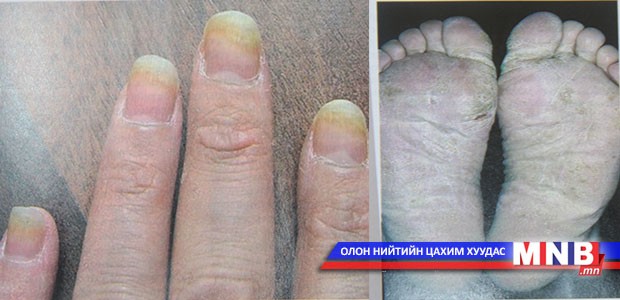 Зарим төрлийн мөөгөнцөр хүний уураг тархийг гэмтээх магадлалтай