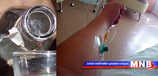 Архины хордлогын улмаас 327 хүн эмнэлэгт ханджээ