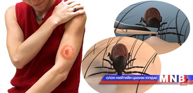 Хачигт халдвараас сэргийлэхийг зөвлөж байна