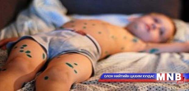 9687 хүн улаанбурханаар өвчлөөд байна