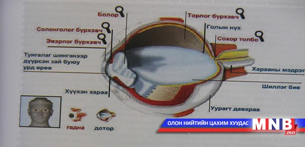 Нүдний даралт ихдэх өвчин