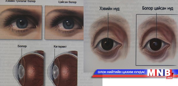 Нүдний болор цайх
