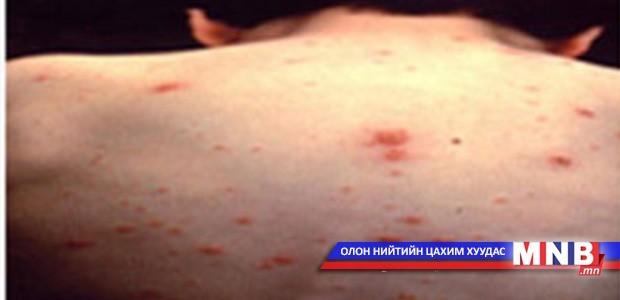 Цочмог, халууралт өвчний хам шинж тасралтгүй мэдээлэгджээ