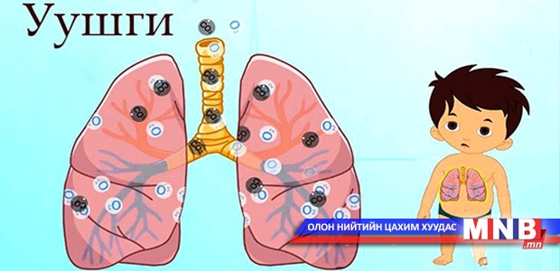 "Уушгины хатгалгаа өвчинтэй тэмцэх дэлхийн өдөр" тохиож байна