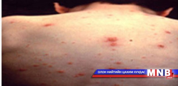 Шинэ цэргүүд улаанбурхан өвчнөөр өвчилжээ