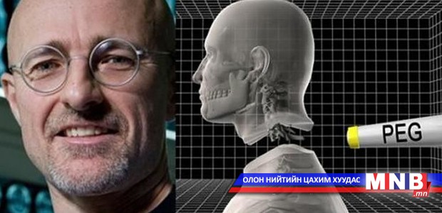 Дэлхийд анх удаа толгой солих мэс заслыг амжилттай хийжээ