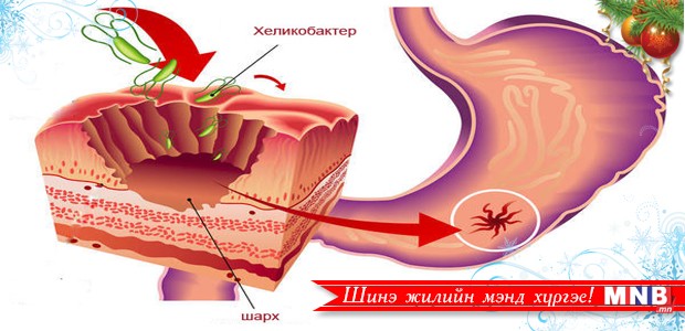 Иргэдийн дунд ходоодны шарх өвчин их байна