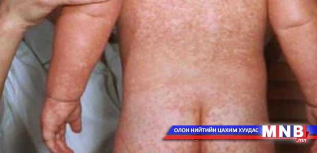 Улаанбурхан өвчний тархалт нэмэгджээ