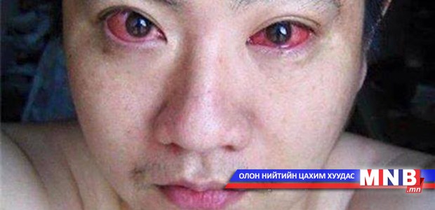 Нүдний хорт хавдар ухаалаг утаснаас үүдэлтэй