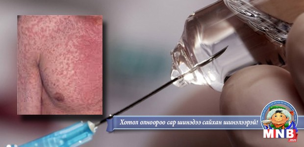 Оюутнуудын дунд улаанбурхан өвчний гаралт буурахгүй байна