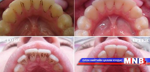 Лимоны шүүс, хүнсний содаар шүдээ цайруулж болно