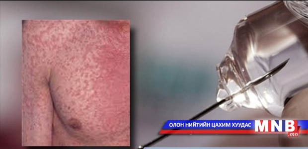 Улаанбурхан өвчний хүнд хэлбэрийн халдвартай 340 хүн эмчлүүлж байна