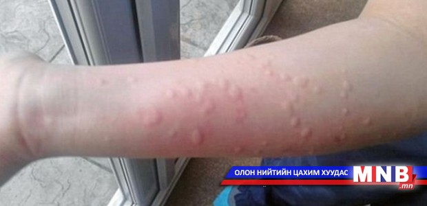 "Чонон хөрвөс” өвчний 40 хувь амьсгалаар халдварладаг