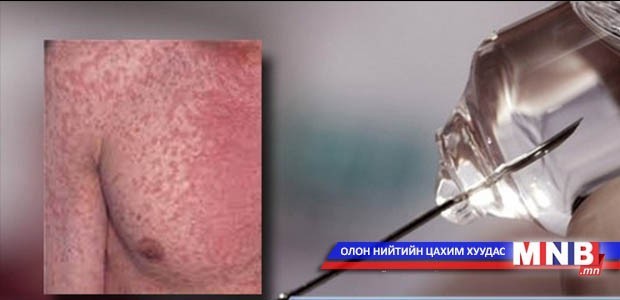 Улаанбурхан өвчтэй 368 хүн эмчлүүлж байна