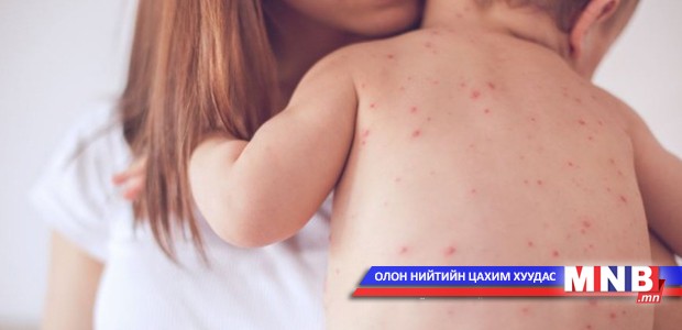 Улаанбурханы эсрэг вакциныг нярай хүүхдэд тарьж болохгүй