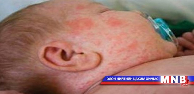 Улаанбурханаар өвдсөн хүүхдээ сахин хэвтэж буй ээжүүд өвдөх нь ихэсчээ