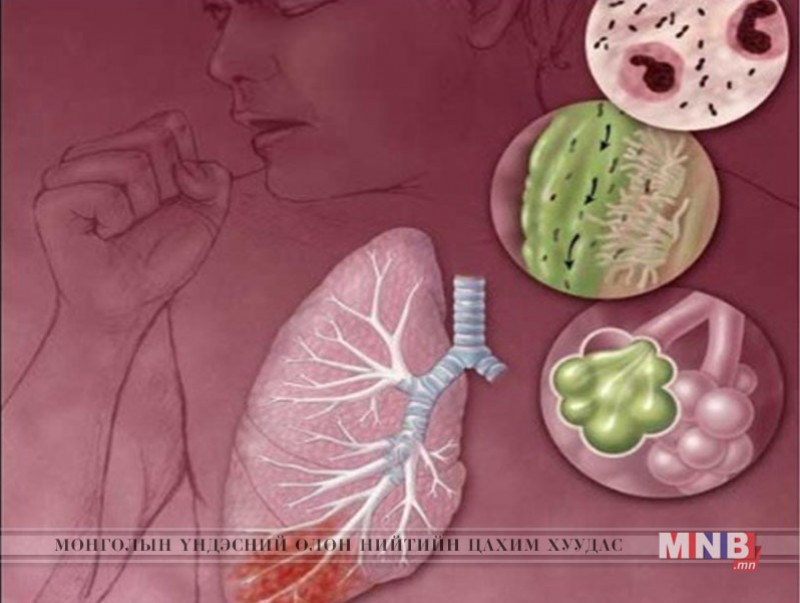 Хатгалгаа өвчин туссан эсэхийг гэрийн нөхцөлд хэрхэн таних вэ