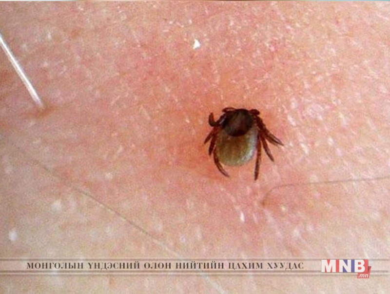 Хачгаар дамжих халдварын 142 тохиолдол бүртгэгджээ