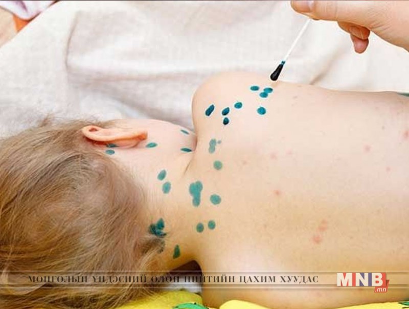 Салхинцэцэг өвчнөөс сэргийлэх зөвлөмж