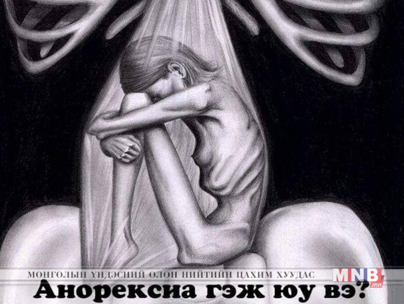 Анорексиа гэж юу вэ