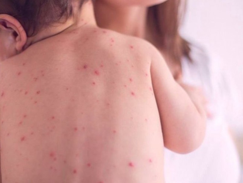 Улсын хэмжээнд Улаанбурхан өвчний батлагдсан 14 тохиолдол бүртгэгджээ