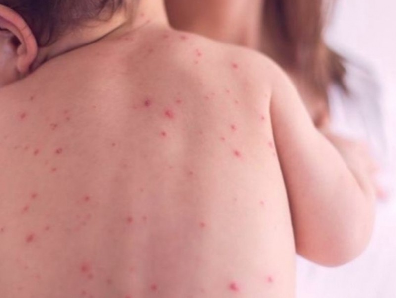 Улаанбурхан өвчин нууц хугацааны 3-5 хоногтоо вирус цусаар дамжина