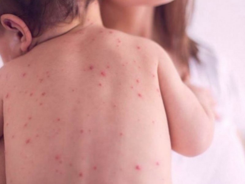 Улаанбурхан өвчин нь халдварлалт өндөртэй ч вакцинаар сэргийлэгдэх боломжтой